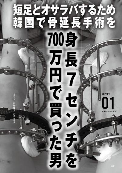 骨延長手術で長身に！身長7センチを７００万で買った体験談